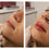 Miniatura: Preenchimento facial