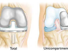 Understanding Partial Knee Replacement Recovery and Knee Recovery Time