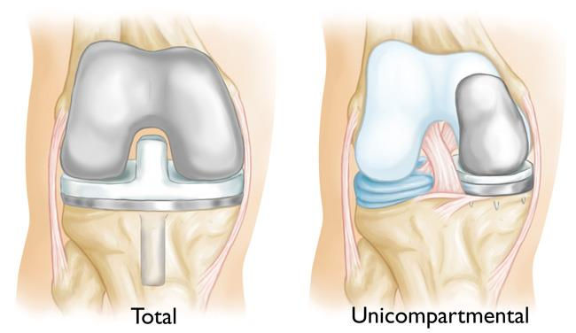 Understanding Partial Knee Replacement Recovery and Knee Recovery Time