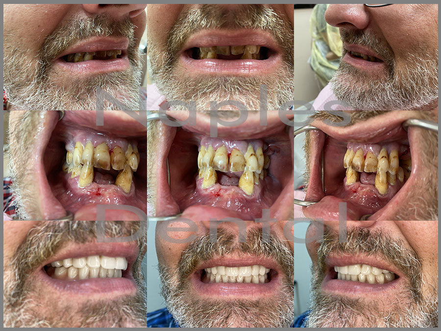 New Before and After Implant Supported Dentures