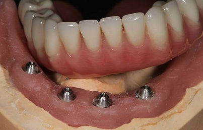 Naples Dental and Implant Center - On-Site Denture Lab - Fitting Dentures