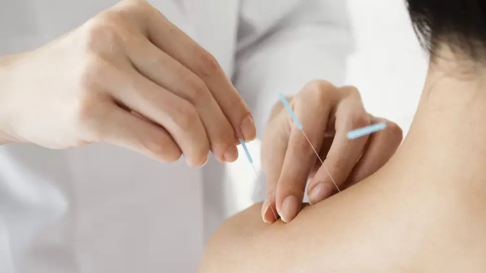 Close-up view of acupuncture needles inserted on a patient’s back