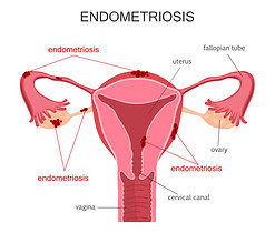 endo.jpg