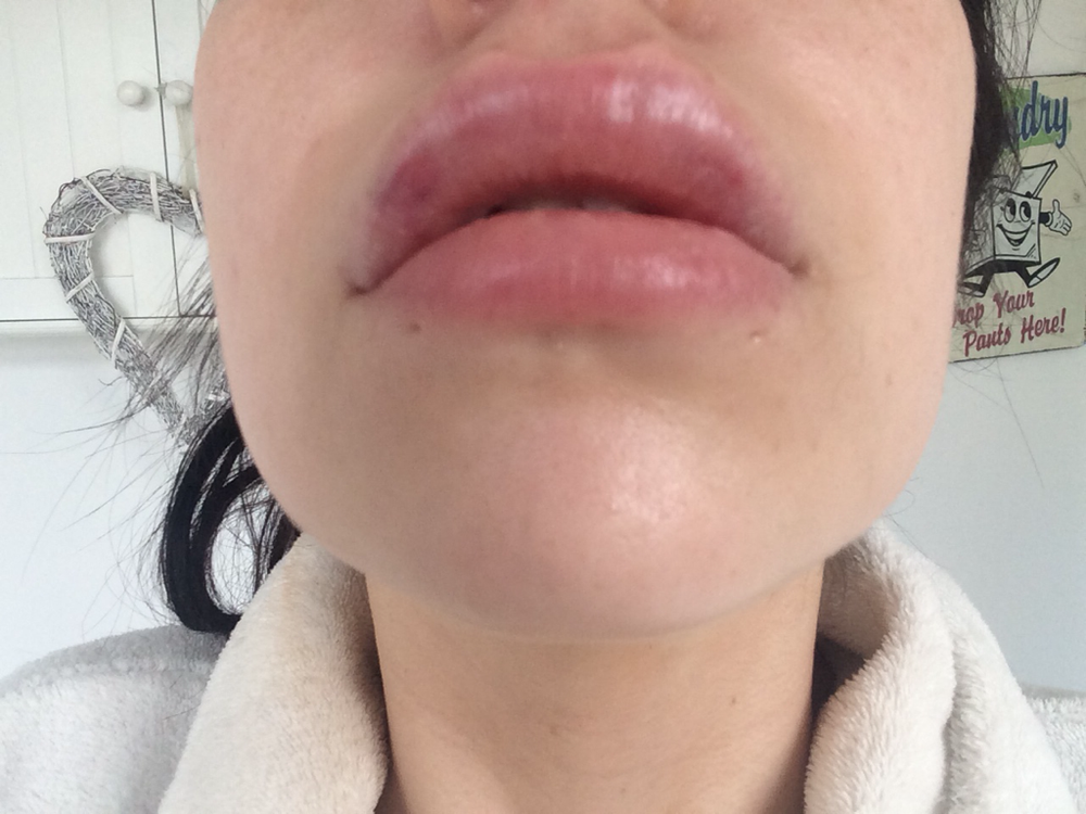 Lip Fillers with Flawless Cosmetic