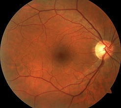 macular degeneration