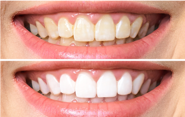 What is Teeth Whitening & Its Benefits?
