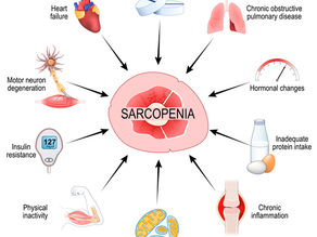 diagram of factors affecting sarcopenia
