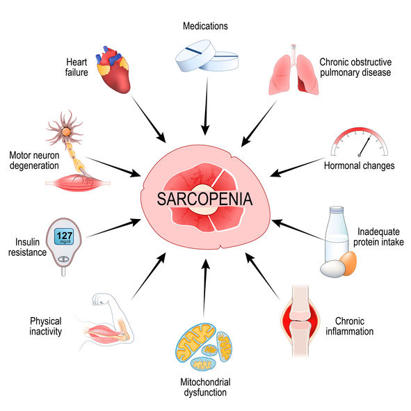 diagram of factors affecting sarcopenia