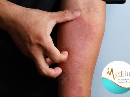 Private dermatology for eczema in Newmarket, Suffolk