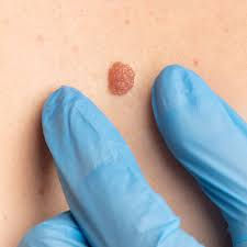 Benign Mole