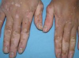 Vitiligo.jpeg