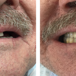 Allan’s Dental Journey: Dental implants in Budapest