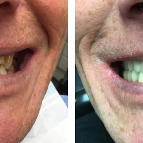 Jesper’s Dental Journey: Dental implant treatment in Budapest