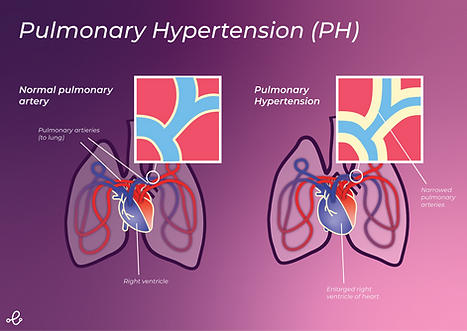 Pulmonary Hypertension Infographic.png