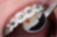 Braces