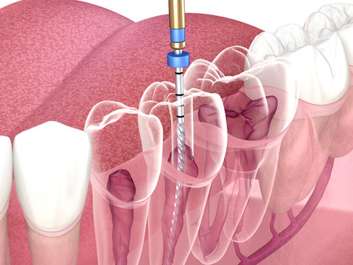 How do I know if I need a root canal?