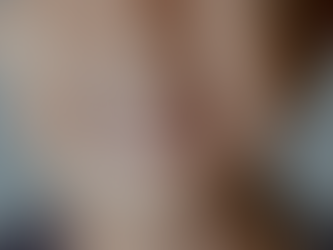 What Is Hyperdontia (Extra Teeth)?