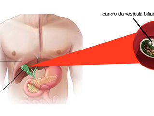Cancro da vesícula biliar - o que é, sintomas, diagnóstico e tratamento