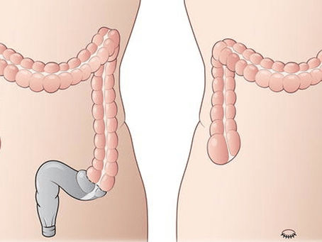 Amputação abdomino-perineal - técnica, indicações, consequências, complicações e recuperação