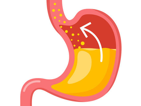 Doença de refluxo gastroesofágico - diagnóstico, tratamento não cirúrgico e tratamento cirúrgico