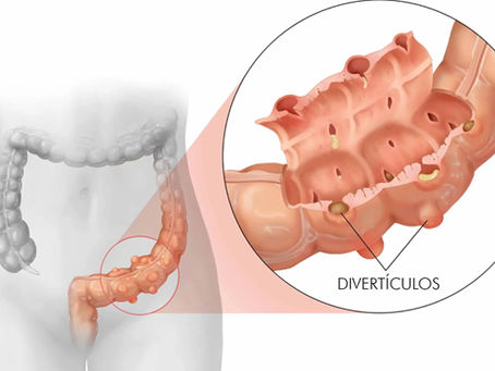 Doença diverticular - quais os sintomas, quando se opera e o que se deve comer