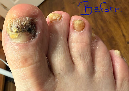 Advanced fungus toenails before STAR NT pedicure