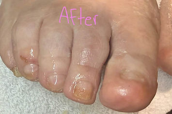 Toes after STAR NT pedi