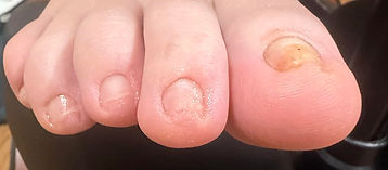 After STAR NT Pedicure for fungus and pincer toenail