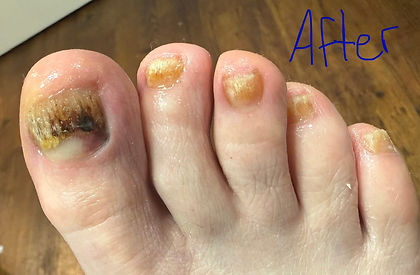 Toenail fungus