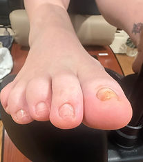 After STAR NT pedicure