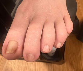Pincer toenail with fungus