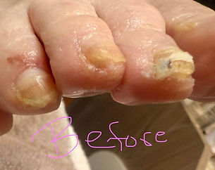 Toenail fungus prior to STAR NT pedi