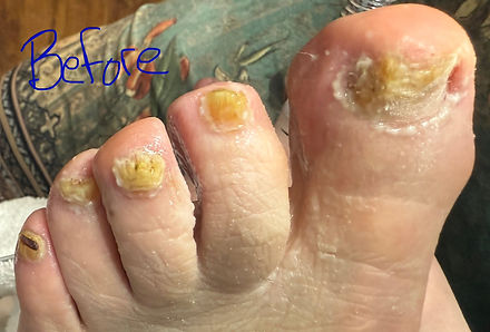 After STAR NT Pedi on toenail fungus