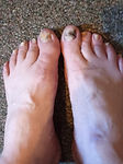 Fungus toenails