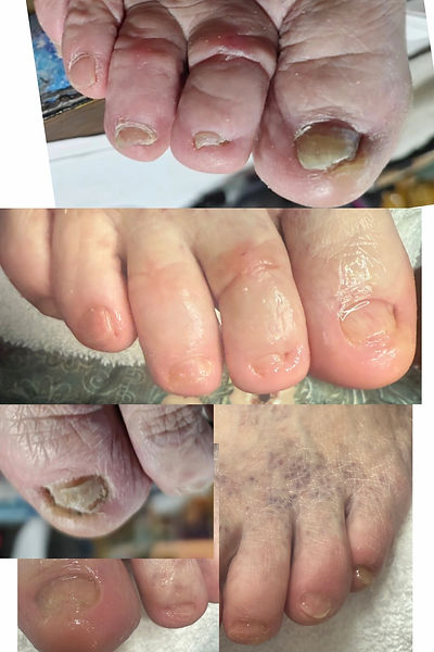 Before and after STAR NT Pedi for Ingrown toenails
