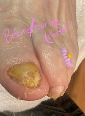 toenail fungus