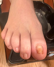 Pincer toenail with fungus