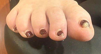 Before STAR NT Pedicure for fungus and pincer toenail
