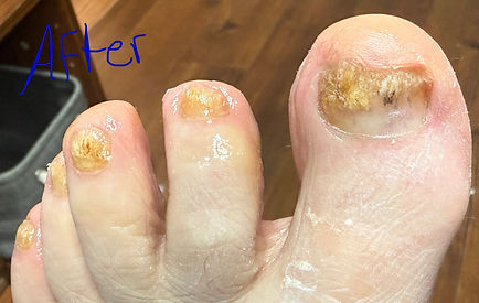After STAR NT Pedi on toenail fungus
