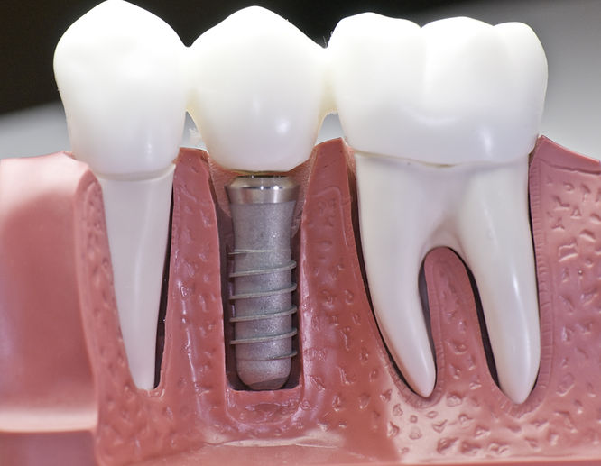This model shows that teeth have been ca