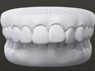 Overbite o Mordida Profunda