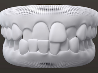 Crossbite o Mordida Cruzada