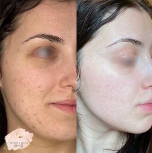 saskatoon acne facials dermaplaning before and after results