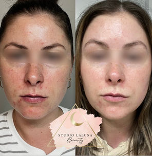 saskatoon acne facials dermaplaning before and after results