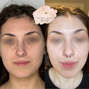 saskatoon acne facials dermaplaning before and after results