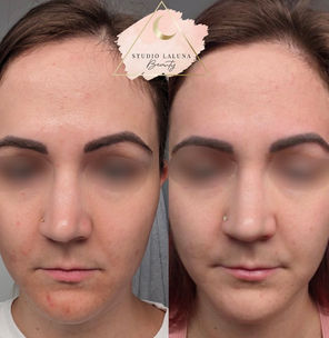 saskatoon acne facials dermaplaning before and after results