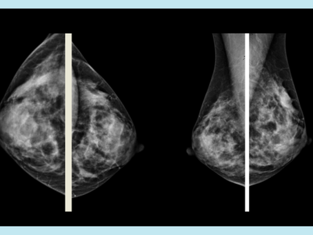 Detección y Manejo de Asimetrías en Mamografías con Contraste