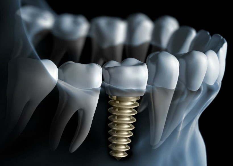 Affordable dental implant kellyville