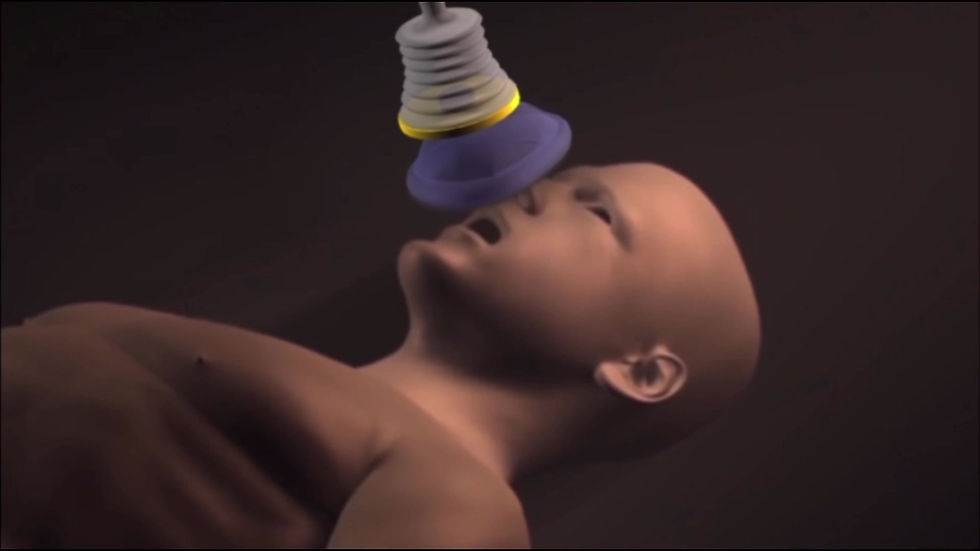 縮圖：美國LifeVac 氣道抽吸器 (哽塞窒息急救)
