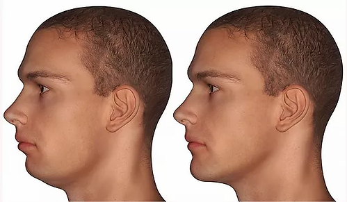 mentoplastiamasculina4-700x460.webp